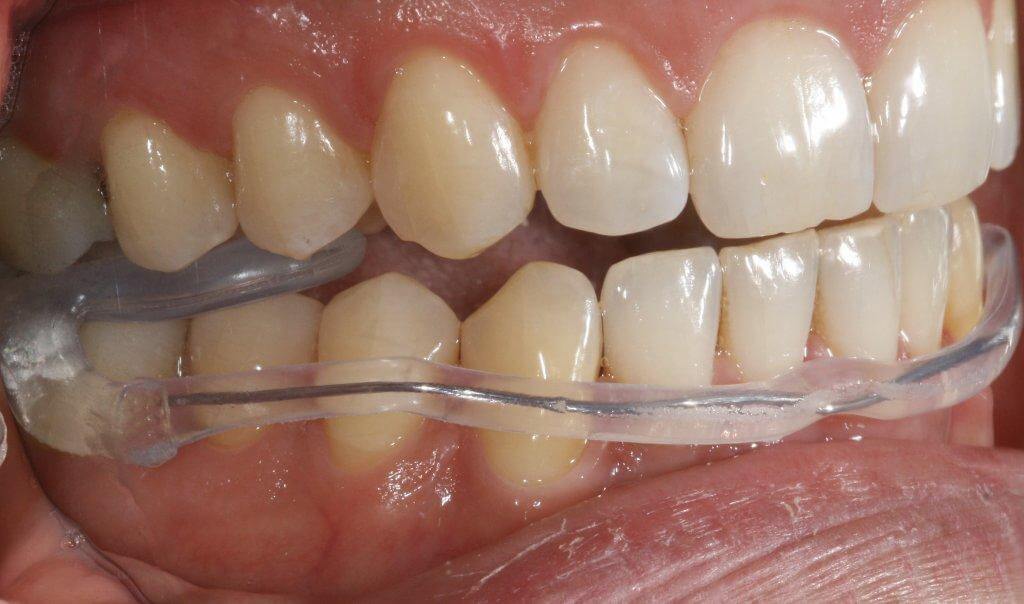 AquaSplint mini (10er Pack)