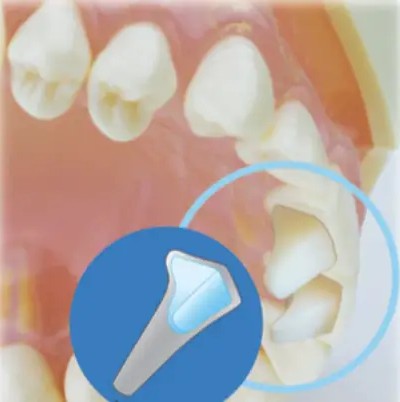 Mini Mold® Bite Jet, 7mm