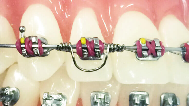 GTS - Goodman Torquing Spring Set