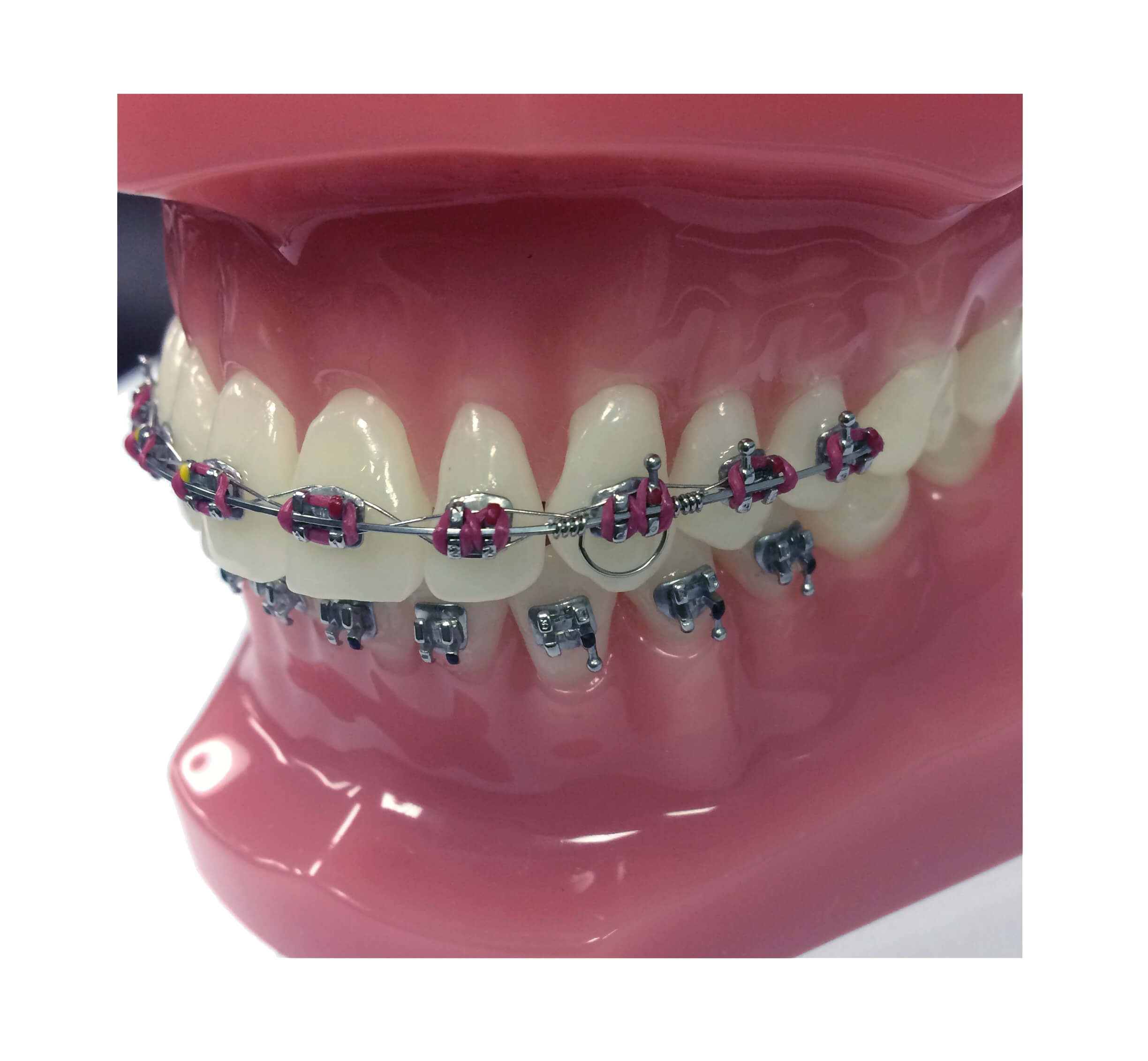 GTS - Goodman Torquing Spring Set