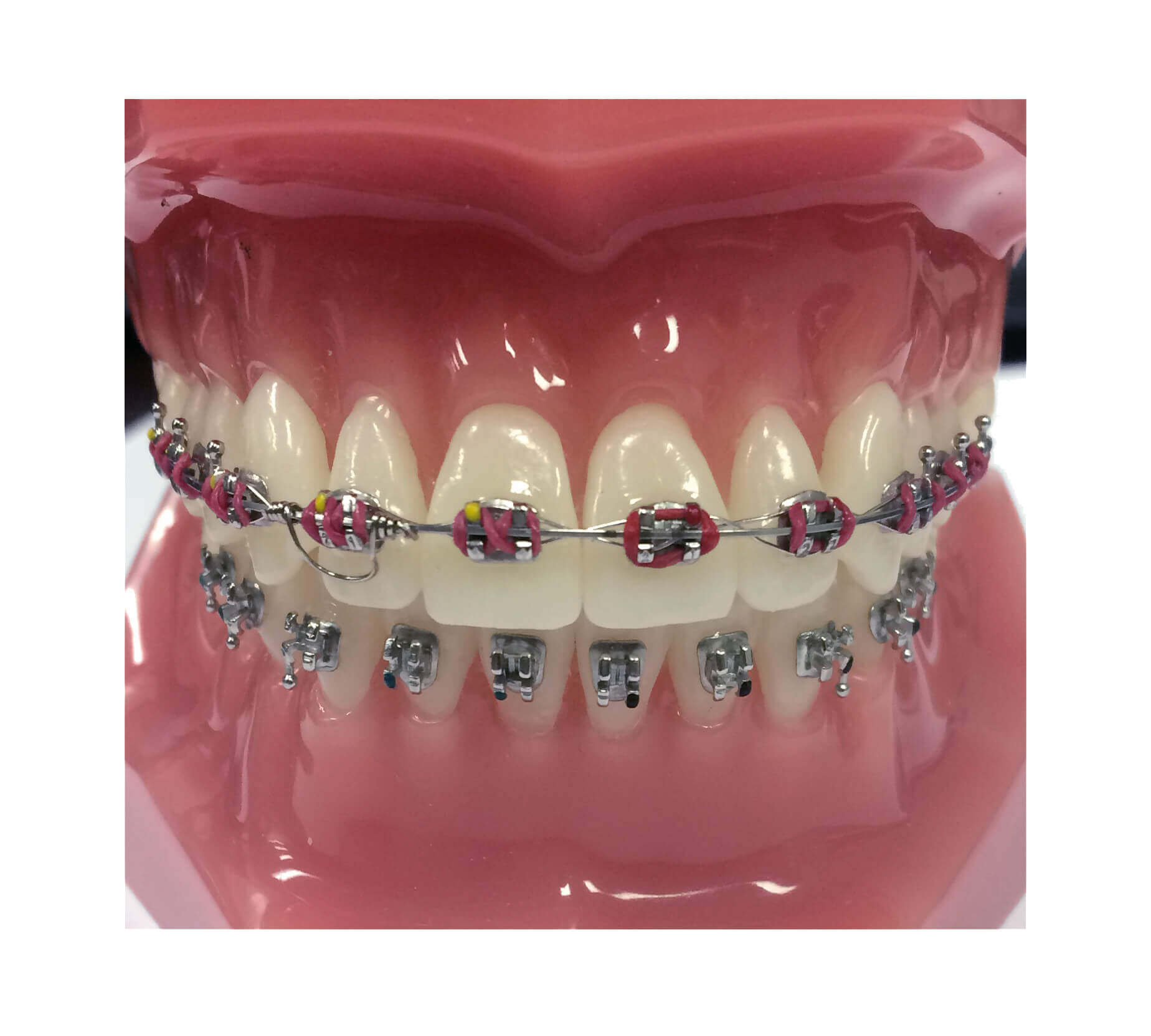 GTS - Goodman Torquing Spring Set