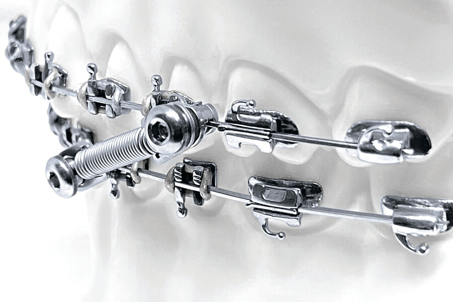 CS5 Twist Lock, 5-Patienten Kit (10 mm)
