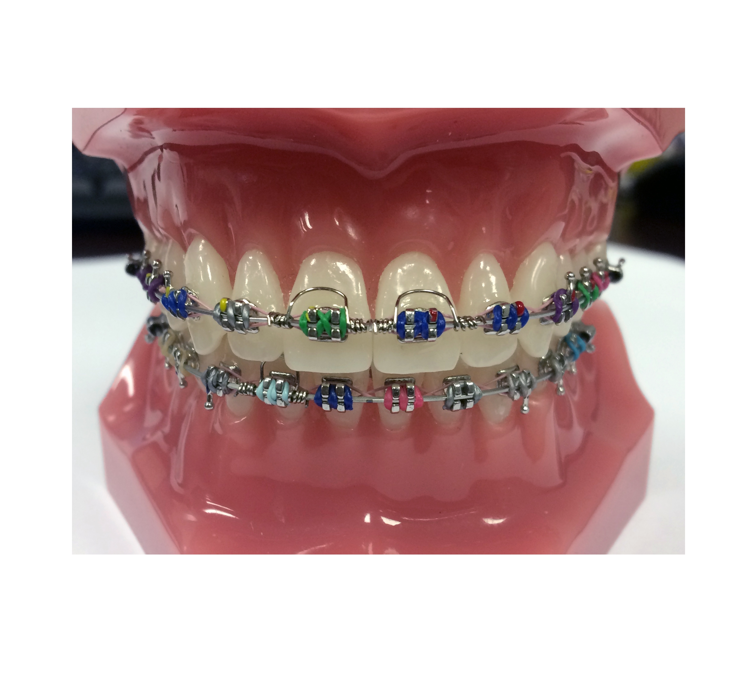 GTS - Goodman Torquing Spring Set