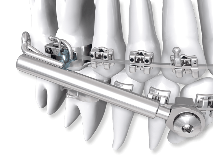 SUS³ - Set ohne Einbauschlüssel (Folgeset)