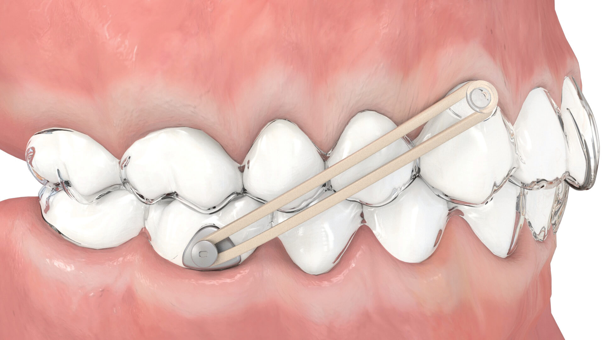 Aligner Buttons, transparent