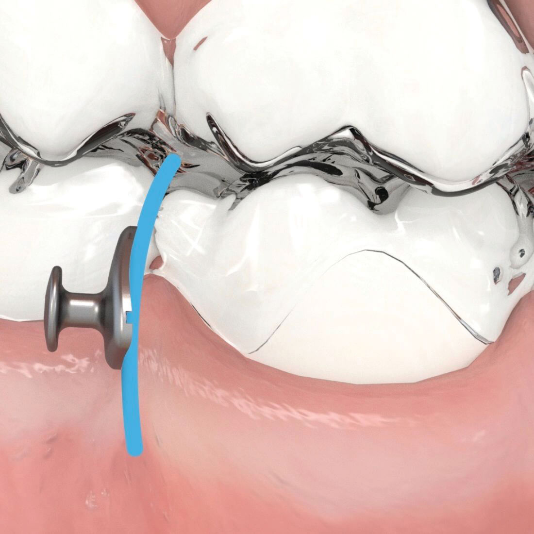 Aligner Buttons, transparent