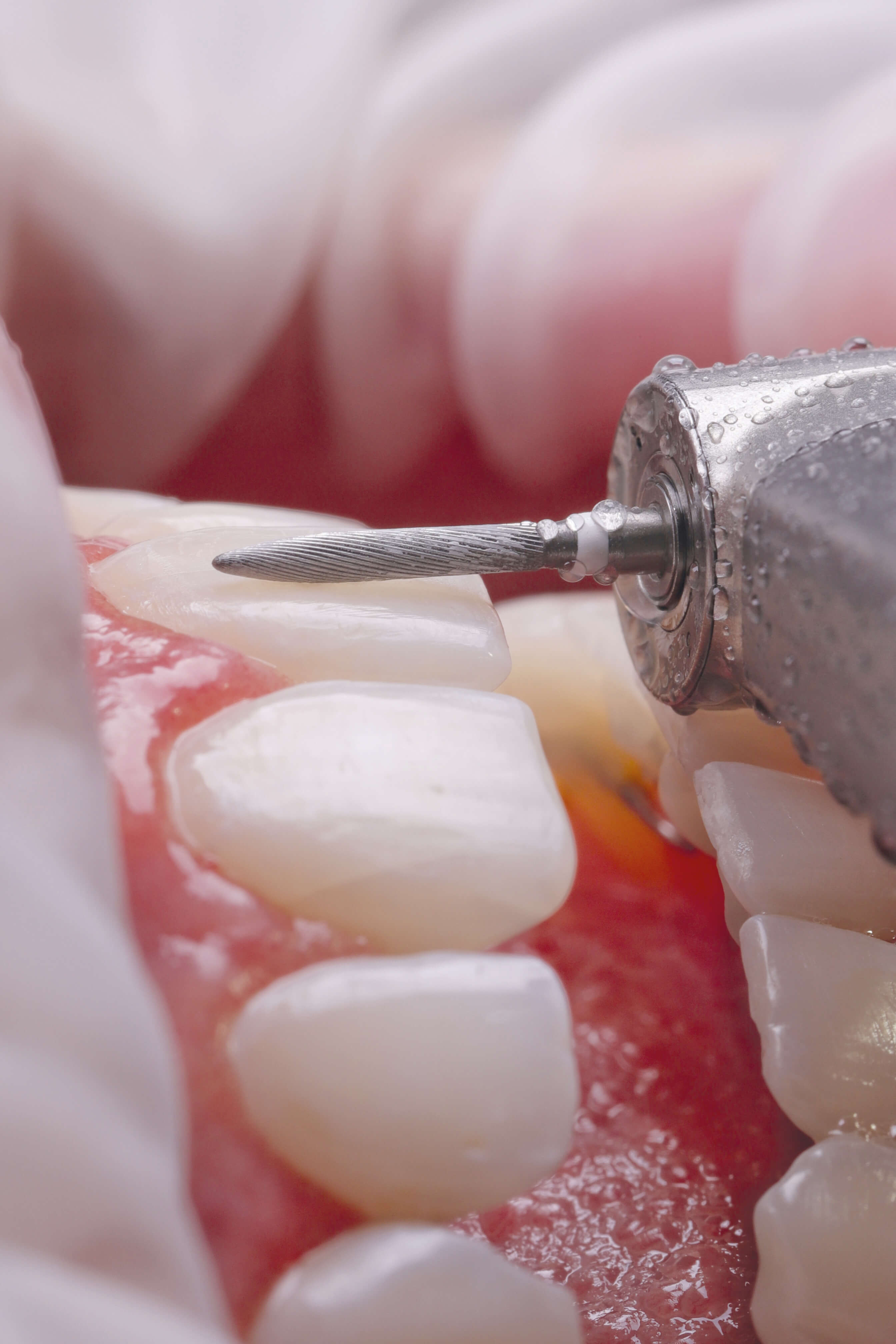 Hartmetall Fräse (Winkelstück), Interdental & Gingivanah, 016