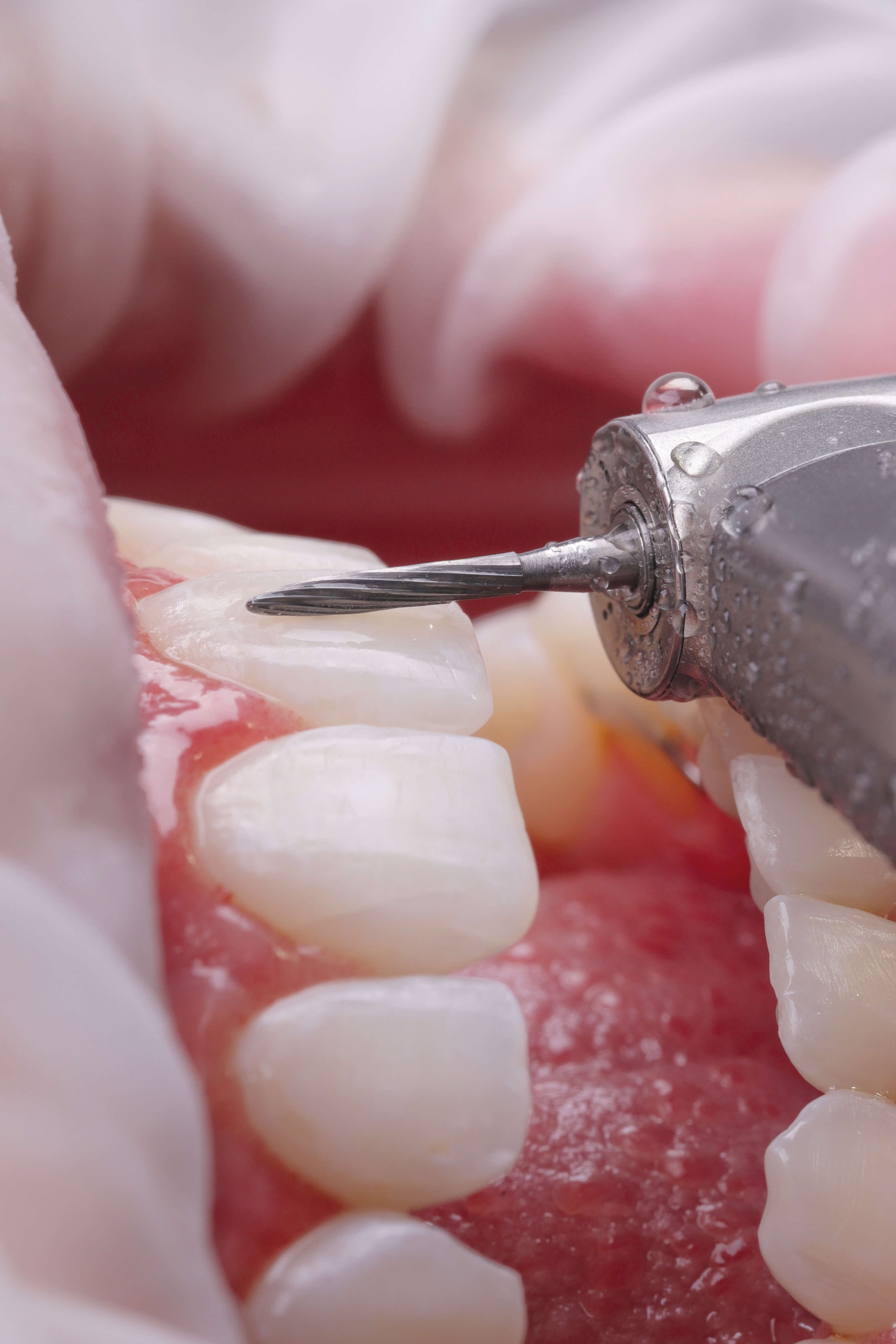 Hartmetall Fräse (Winkelstück), Interdental & Gingivanah, 016