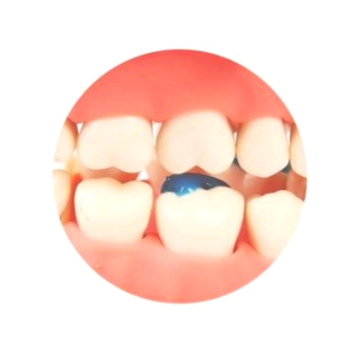 Band Zement "BLUE" Spritze