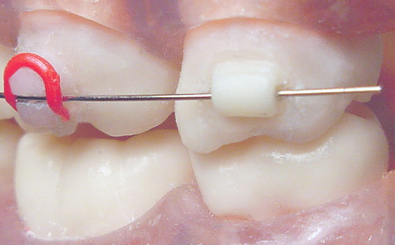 Mini Mold® Starter Kit