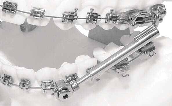 SUS³ - Set ohne Einbauschlüssel (Folgeset)