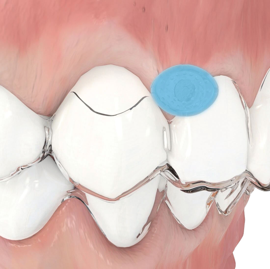 Aligner Buttons, transparent