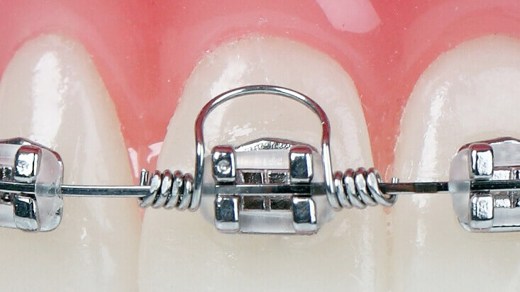 GTS - Goodman Torquing Spring Set